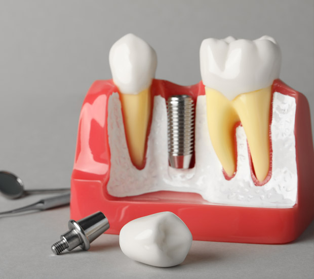 San Bruno Dental Implant Surgery