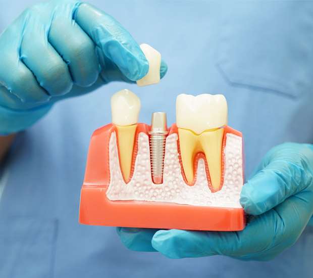 San Bruno Questions to Ask at Your Dental Implants Consultation
