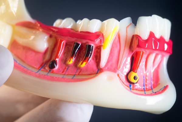 Ways Endodontics Can Improve Your Smile